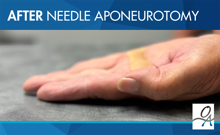 After Needle Aponeurotomy