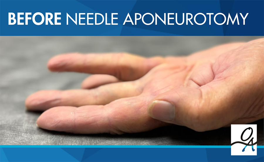 Before Needle Aponeurotomy